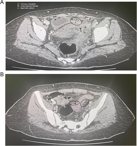 (A) Axial section of the abdominopelvic CT scan showing the colovesical fistula. (B) Axial section of the abdominopelvic CT scan showing the diverticular disease of the colon.