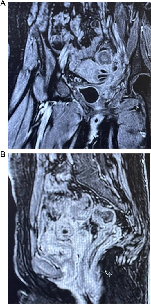 MRI scan.