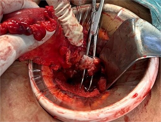 Intraoperative finding of the colovesical fistula.