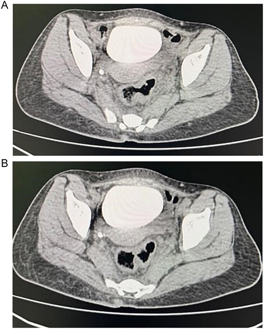 Showing axial section of the abdominopelvic CT scan with cystogram showing contrast filled urinary bladder with no clear vesicorectal or vesicovaginal fistula.