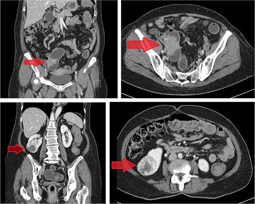 Contrast-enhanced CT images of case 1. Top-left: Coronal view of the sigmoid colon cancer. Top-right: Transverse view of the CRC. Bottom-left: Coronal view of the renal cell carcinoma (RCC). Bottom-right: Transverse view of the RCC.