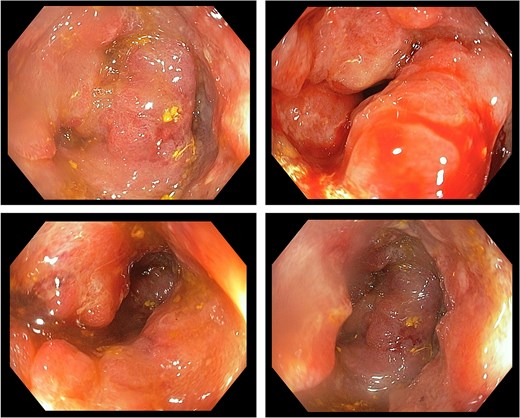 Colonoscopic image of case 2 showing a circumferential, proliferative mass occupying 100% of the lumen, located 25–30 cm from the anal verge.