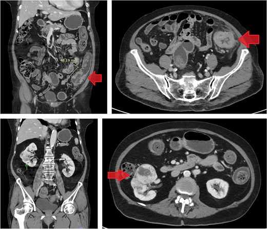 Contrast-enhanced CT images of case 2. Top-left: Coronal view of the sigmoid colon cancer. Top-right: Transverse view of the CRC. Bottom-left: Coronal view of the RCC. Bottom-right: Transverse view of the RCC.