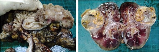 Surgical specimen of case 1 showing synchronous tumors: Sigmoid colon cancer on the right and RCC on the left.