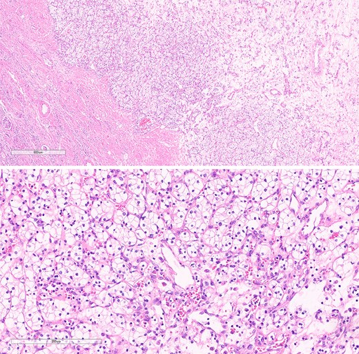 The histological section of RCC shows clear cytoplasm and cellular morphology consistent with clear cell RCC.
