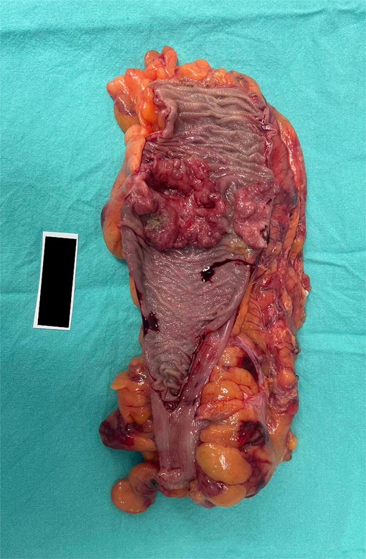 Surgical specimen from case 2 demonstrating sigmoid colon cancer.