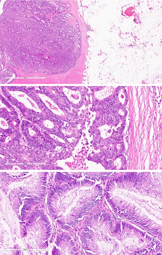 Histological section of sigmoid colon cancer showing atypical glandular structures consistent with adenocarcinoma.