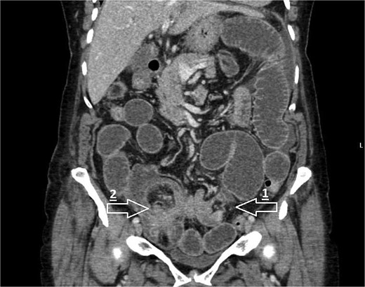 CT coronal image demonstrating small bowel obstruction secondary to ileo-colic intussusception with large segment of small bowel invaginating into caecum. Arrows mark the following: 1—transition point of bowel obstruction, 2—ileo-caecal intussusception ‘lead point’.