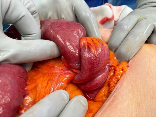 Intra-operative photograph showing ileo-colic intussusception—the small bowel and its mesentery is seen invaginating into the caecum.