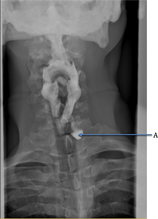 Coronal view of fluoroscopic swallow showing Killian-Jamieson esophageal diverticulum labeled A.