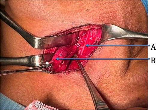 Intra-operative photograph. A: RLN, B: KJD.