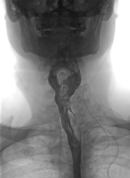 Coronal view of postoperative fluoroscopic swallow study demonstrating no evidence of remnant diverticulum or leak.