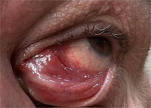 A well-defined pink-red mass in the left caruncular region, appearing localized without ulceration or bleeding. On palpation, the lesion was firm-elastic, with no signs of infection or inflammation in the surrounding conjunctival or adnexal tissues.