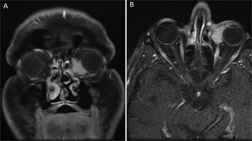 Orbital MRI images of the patient (A) Coronal T1-weighted orbital MRI showing a well-defined lesion in the left caruncular region. The mass measures ~23 × 34 mm and extends to the medial and inferior orbital walls, with homogenous contrast enhancement. No significant infiltration into adjacent structures is observed. (B) Axial T1-weighted orbital MRI showing a homogeneously enhancing mass in the left caruncular region. The lesion extends to the medial and inferior orbital walls without significant involvement of adjacent orbital structures. The mass demonstrates clear boundaries and no evidence of periorbital tissue infiltration.