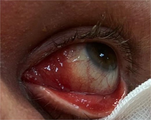 Postoperative clinical image of the left eye showing the caruncular region after incisional biopsy. The surgical site appears clean, with mild erythema and no signs of infection or significant inflammation. The conjunctival and adnexal tissues are intact, and no residual mass is visible.