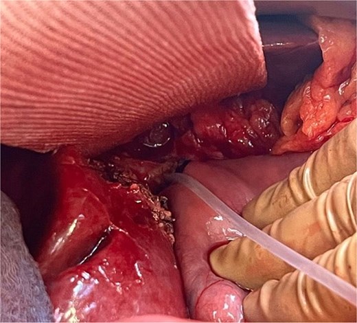Conjunction of the left-sided bile ducts into a single hepaticojejunostomy. The right-sided duct required a separate hepaticojejunostomy using the same jejunal limb. To prevent complications, transhepatic external-internal biliary drains were placed in the left-sided anastomosis, extending into the jejunum.