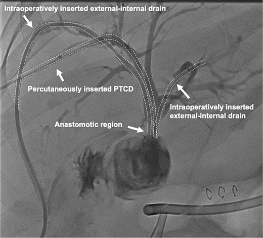 Contrast-enhanced image of the intraoperatively inserted external-internal drains and the percutaneous transhepatic cholangiography drainage (PTCD) which was interventionally inserted into the right duct on postoperative day one.