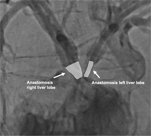 Contrast-enhanced image of both hepaticojejunostomy anastomoses 4 weeks after biliary reconstruction.