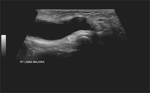 US of the right inguinal area showing oblong cystic lesion measuring 6.5 × 3 cm, extending through the right inguinal canal into the labium majus (arrow).