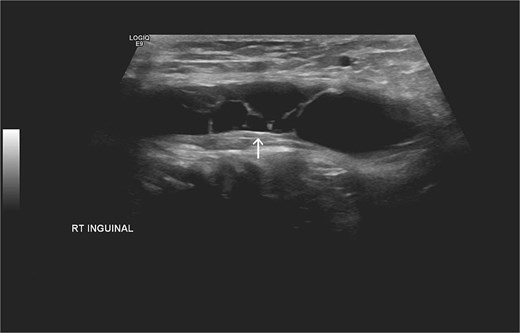 Additional US of the right inguinal area showing fine internal septations of the lesion as indicated by the arrow.