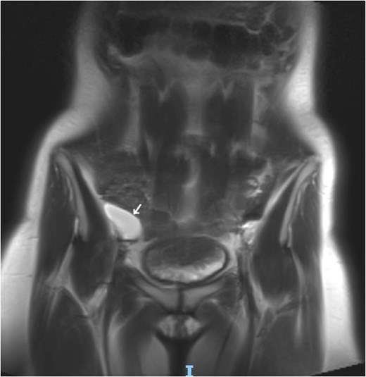 Coronal MRI view of the pelvis, showing well-defined cystic lesion with low T1 and high T2 signal intensity, measuring ~ 7 × 3.5 cm (arrow).