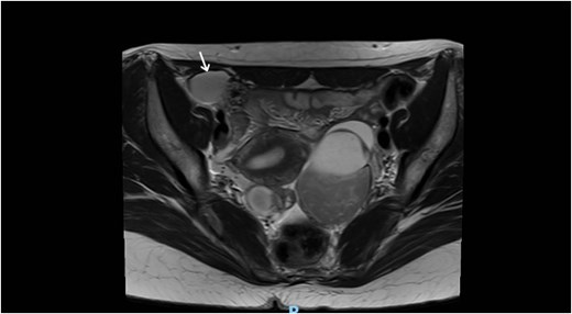 Axial MRI view of the pelvis, showing the extension of the cyst into the right inguinal canal with no bowel or omental herniation (arrow).