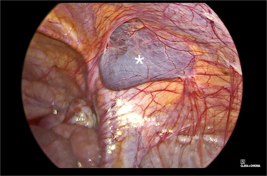 Intraoperative view of the right inguinal area, demonstrating a bluish-gray, fluid-filled sac (marked with an asterisk in the image). The surrounding structures appeared normal and showed typical anatomy.