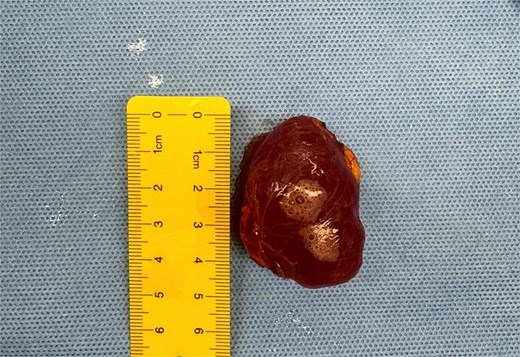 Intraoperative finding showing the excised specimen, which was fluid-filled and reddish-brown in color with smooth, glossy appearance.
