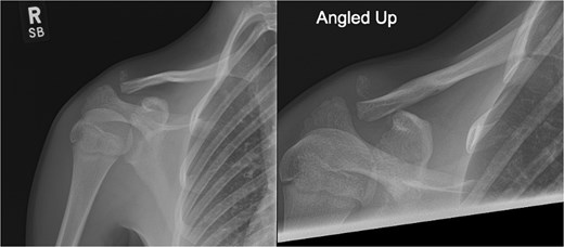 Radiographs of first case showing a displaced Neer type IV lateral clavicle fracture with deformity and displacement.