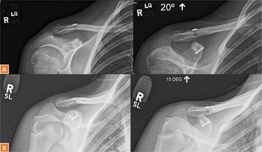 (A, B) Radiographs showing complete healing of the first case and union at 3 months and 12 months post-operatively.