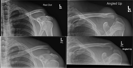 Radiographs of second case showing a displaced lateral end clavicle fracture with deformity and dorsal displacement.