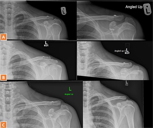 (A–C) Radiographs showing complete healing of the second case and union at 3, 6, and 12 months post-operatively.
