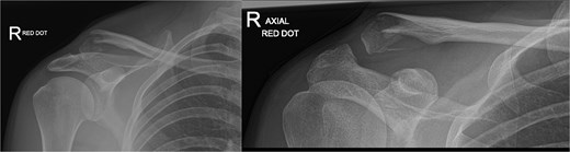 Radiographs of third case showing a displaced lateral clavicle fracture with deformity.