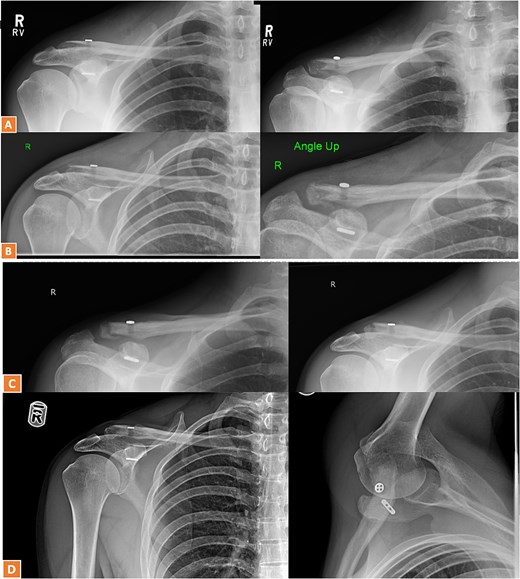 (A, B) Radiographs showing healing of the third case and radiological union at 6 weeks and 3 months post-operatively. (C–D) Radiographs showing complete healing of the third case and union at 6 months and 12 months post-operatively.