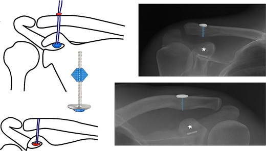 Schematic diagram of fixation of lateral end clavicle with TightRope alongside corresponding radiographic reference points for the surgical technique.