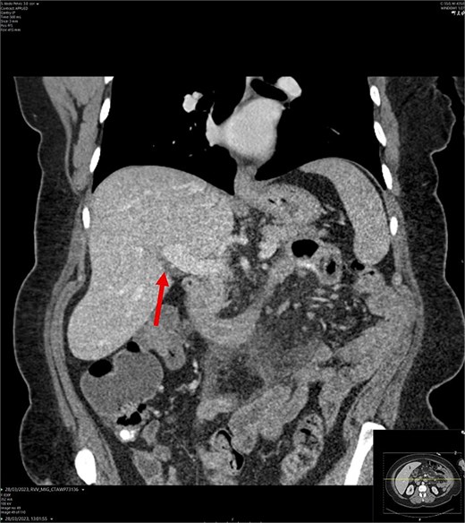 CT abdomen-pelvis scan in coronal view. The arrow points to where we expect the gallbladder to be seen, but it cannot be visualized on the scan.