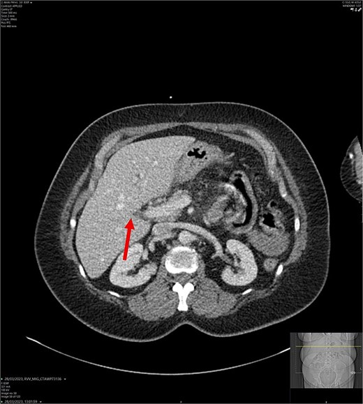 CT abdomen-pelvis scan in axial view. The arrow points to where we expect the gallbladder to be seen, but it cannot be visualized on the scan.