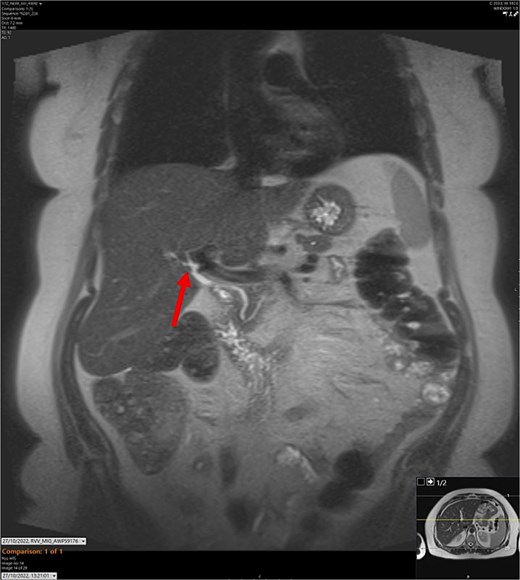 T2-weighted MRCP scan in coronal view. The arrow points to where we expect the gallbladder to be seen, but it cannot be visualized on the scan.