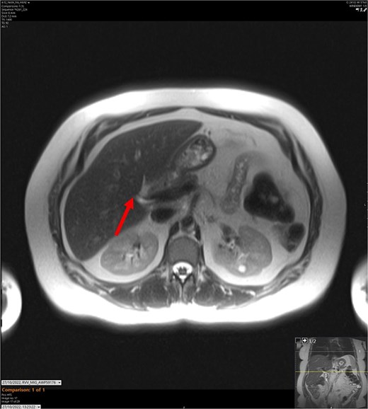T2-weighted MRCP scan in axial view. The arrow points to where we expect the gallbladder to be seen, but it cannot be visualized on the scan.