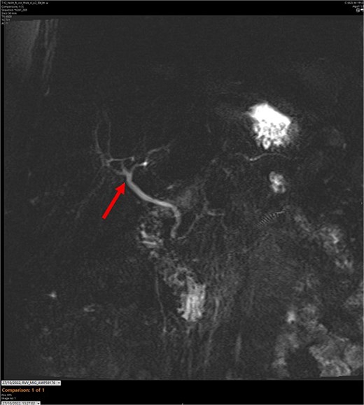 MR maximum intensity projection scan. The arrow points to the largely intact biliary tree. The cystic duct cannot be seen branching from the common bile duct.