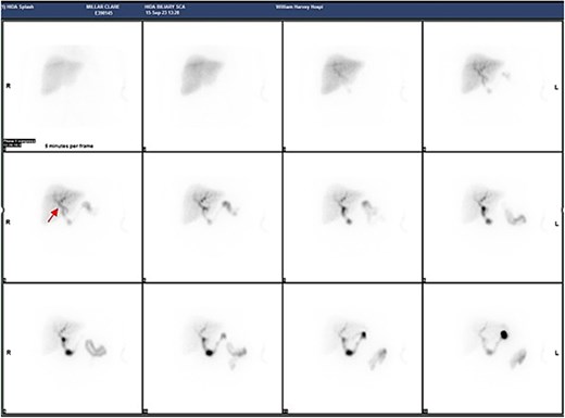 Series of HIDA scans. The arrow points to likely a gallbladder bud.