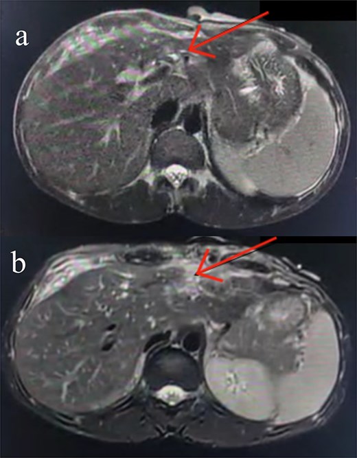 Axial contrast-enhanced abdominal CT images. (a) Subtle injury to the intrahepatic biliary radicals in the left hepatic lobe. (b) Linear laceration on the anterior surface of the liver.