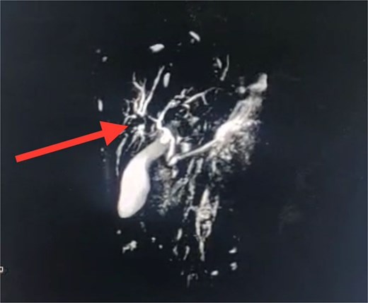 A coronal MRCP image highlighting disruption at the level of the left intrahepatic biliary radicals, suggestive of a biliary leak. The discontinuity is evident at the confluence of the left hepatic duct (arrow), corresponding with the previously identified liver laceration. The extrahepatic biliary tree appears normal with no signs of obstruction or dilatation.