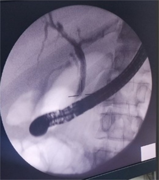 ERCP image showing a normal biliary system. A biliary stent was successfully placed in the right hepatic duct.