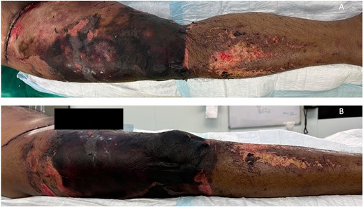 Case highlight 1—Severe circumferential necrosis of the thigh.