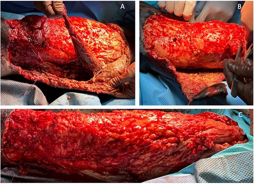 Case highlight 1—Intraoperative image showing debridement, skin, and muscle excision.