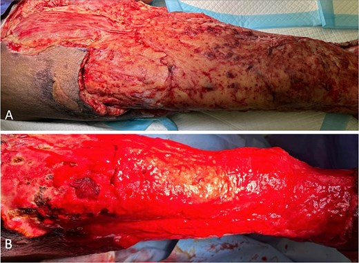Case highlight 1—Intraoperative image of third session of debridement ⁓1 month after initial trauma.