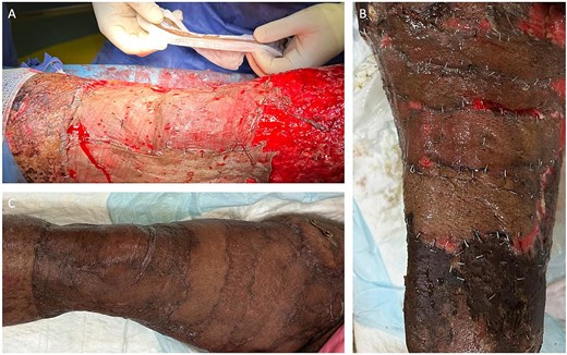 Intraoperative and postoperative images from case 1 following multiple split thickness grafts.