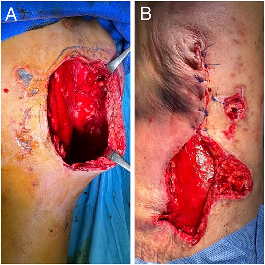 Intraoperative images from case 2 showing large dead space and subsequent layered closure.