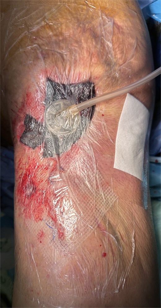 Intraoperative image from case 2 showing negative pressure wound therapy.